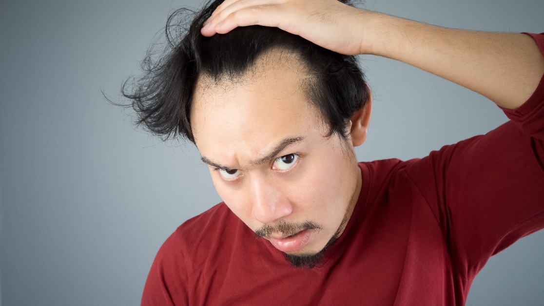 Ai có nguy cơ hói đầu di truyền